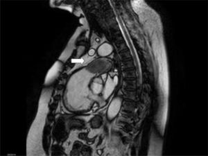 RM torácica (corte sagital), que muestra voluminoso defecto intraluminal con refuerzo variable («seudotrombo») en el tronco común de la arteria pulmonar (flecha blanca).