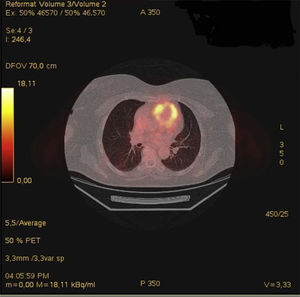 PET/TC destaca la lesión focal hipermetabólica (flecha azul) en el tronco de la arteria pulmonar, sugestiva de malignidad (sarcoma endoluminal).
