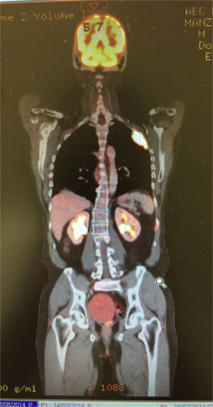 PET-CT con lesión metastásica hipermetabólica.