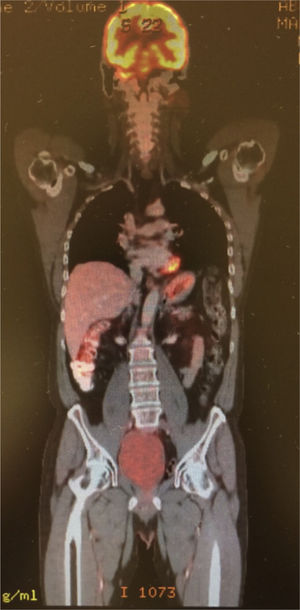 Imagen PET-CT con respuesta completa metabólica y por imagen.