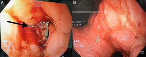 Tumor gástrico Bormann III, lesión a nivel del antro, ulcerada infiltrativa circunferencial, la cual estenosa antro y píloro.