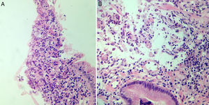 Adenocarcinoma poco diferenciado (G3), de tipo difuso con células en anillo de sello.