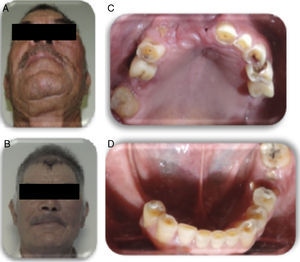 Fotografías iniciales. A) Facial submentovertex. B) Facial de frente. C) Comunicación con antro maxilar. D) Arcada inferior. Fuente: Elaboración propia.