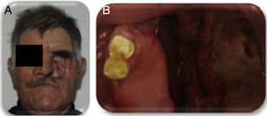 Posoperatorio a un mes. A) Defecto facial. B) Defecto maxilar. Fuente: Elaboración propia.