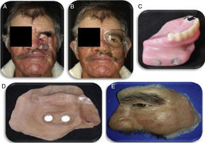 Prótesis facial provisional. A) Vista de frente con obturador en posición. B) Vista de frente con prótesis facial. C) Obturador transicional. D) Imanes fijos a la prótesis facial. E) Prótesis facial provisional terminada. Fuente: Elaboración propia.