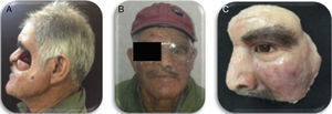 Segunda prótesis combinada finalizada. A) Obturador con pantalla vestibular. B) Vista frontal. C) Prótesis facial definitiva. Fuente: Elaboración propia.