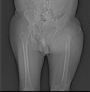 Radiografía AP de la pelvis y del fémur, destrucción de la porción proximal del fémur y el acetábulo izquierdo.