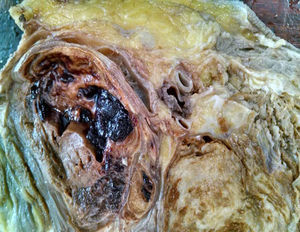 Fotografia macroscópica donde se identifica distorción anatómica con destrucción osea y tejidos blandos.