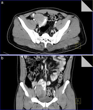 Tomografía simple y contrastada de abdomen en corte axial y con reconstrucción coronal. a) Corte axial donde se identifica un tumor bien definido, redondo, dependiente de la pared del yeyuno, con marcada afinidad por medio de contraste, sin infiltración a tejidos adyacentes. b) Corte coronal donde se confirma dependencia del tumor a pared de asa yeyunal, condicionando moldeamiento del techo vesical sin pérdida de interfase que evidencie infiltración.