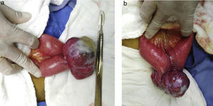 a y b. Tumor dependiente de intestino delgado (yeyuno) en borde antimesentérico, con dimensiones de 7×5×5cm, vascularizado y de bordes regulares.