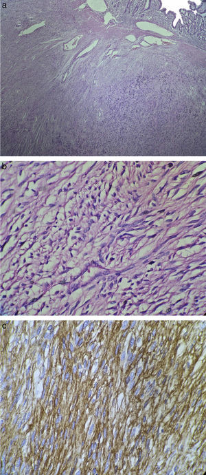 Cortes de histopatología. a) Vista panorámica de la neoplasia que se encuentra por debajo de la mucosa. b) Acercamiento de la neoplasia, visualizando células fusiformes sin atipia celular. c) Reactividad de las células neoplásicas para CD117.