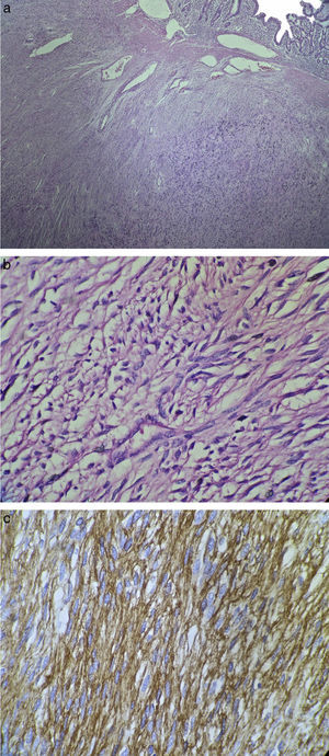 Cortes de histopatología. a) Vista panorámica de la neoplasia que se encuentra por debajo de la mucosa. b) Acercamiento de la neoplasia, visualizando células fusiformes sin atipia celular. c) Reactividad de las células neoplásicas para CD117.