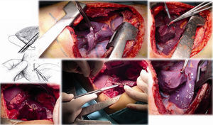 Resección en cuña de lesiones de lóbulo inferior derecho de un tumor de células gigantes.