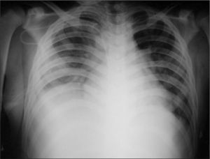 Radiografía de tórax que evidencia aumento en la densidad del hemitórax derecho con borramiento del receso costofrénico ipsolateral por derrame pleural y opacidades de patrón alveolar en el parénquima pulmonar adyacente.