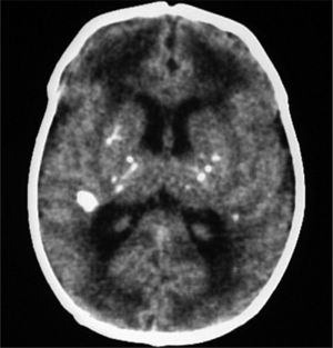 Tomografía craneal; afectación sustancia blanca periventricular.