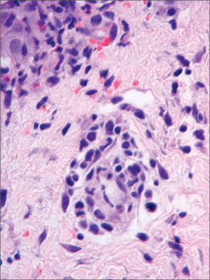 Infiltrado dérmico perivascular de células mononucleares atípicas (HE × 160).