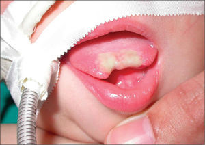 Úlcera necrosante en porción distal de la lengua.