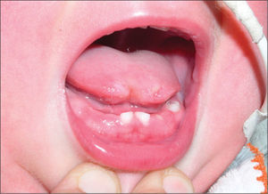 Aspecto de la lengua tras la cicatrización de la lesión.