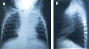 Radiografía anteroposterior (A) y lateral (B): opacidad con semiología de masa extrapleural que se proyecta sobre el lóbulo superior izquierdo y espacio retroesternal.