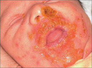 Fisuración perioral con edema palpebral.