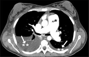 TC pulmonar helicoidal con contraste. *AP: arteria pulmonar. **Derrame pleural.