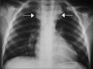 La radiografía de tórax muestra una masa en el mediastino posterosuperior con desplazamiento de la tráquea hacia la izquierda.