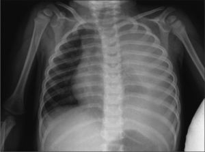 Radiografía de tórax en la que se observa un derrame pleural izquierdo masivo con colapso del pulmón ipsolateral y desplazamiento mediastínico a la derecha.