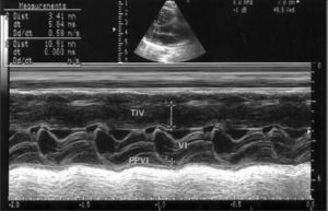 Ecocardiografía en modo M. Se aprecia engrosamiento del tabique intraventricular (10,9mm).