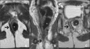 Paciente con ARPSP. Posicionamiento excéntrico del anorrecto descendido (R) respecto al elevador del ano (flechas) y complejo muscular esfinteriano. Planos axial (A) y coronal (B) potenciados en T1, y axial potenciado en T2 (C).