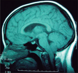 RM craneal. Corte sagital. Secuencia ponderada en T1. Descenso de las amígdalas cerebelosas hacia el canal medular.
