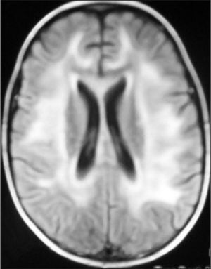 FLAIR. Afectación cortical y de sustancia blanca en región parietooccipital sugestivas de LEPR.