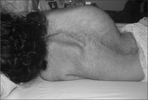 Escoliosis severa dorsal derecha, lumbar izquierda.