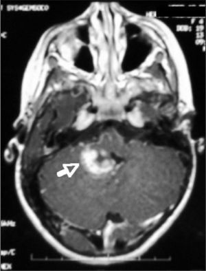 Imagen de resonancia magnética en corte axial donde se visualiza un tumor con origen en el pedúnculo cerebeloso derecho.