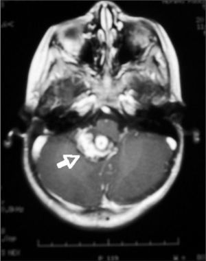 Imagen de resonancia magnética en corte axial donde se visualiza recidiva local, con ocupación de la vermis inferior, el suelo del IV ventrículo y una pequeña parte de hemisferio cerebeloso derecho.