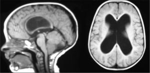 Resonancia magnética cerebral: ventriculomegalia no hipertensiva con disminución de sustancia blanca y adelgazamiento del cuerpo calloso.