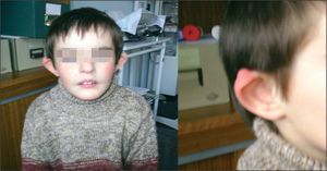Paciente afectado de trisomía parcial 4q (q31-q35). En su fenotipo destaca la displasia auricular, las hendiduras palpebrales antimongoloides y la desviación de la comisura bucal hacia abajo.