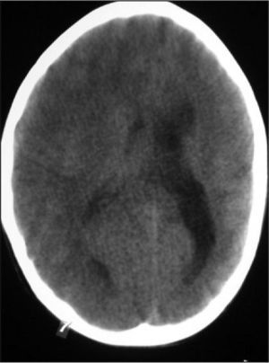 TC craneal. Respecto a la imagen tomográfica anterior, se aprecia la disminución en el tamaño del ventrículo derecho.