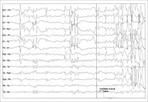 EEG en vigilia que muestra la asimetría en la actividad de base de ambos hemisferios cerebrales, junto a la actividad punta-onda frontal derecha.