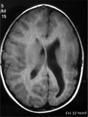 Resonancia magnética craneal ponderada en T1. Alteración de la morfología y señal de surcos (polimicrogiria) en hemisferio izquierdo. Aumento generalizado del hemisferio supratentorial derecho. El ventrículo lateral derecho es de menor tamaño que el izquierdo.
