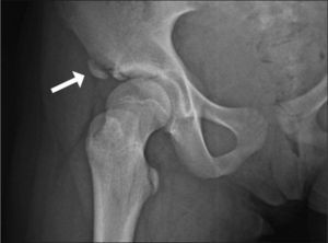 Radiografía de cadera del caso clínico 2. Avulsión de espina ilíaca anteroinferior.