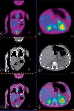 Imágenes sagital y axial de PET (superior), TC (central) y fusión PET-TC (inferior) correspondientes al estudio PET-TC con 18F-fluoro-L-DOPA del paciente de 13 meses con CHI focal, en las que muestra un foco hipercaptante en el cuerpo del páncreas (flecha blanca).