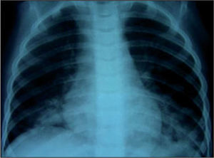 Radiografía de tórax al ingreso (caso 1).
