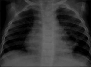 Radiografía de tórax a los 13 días del episodio de broncoaspiración (caso 2).