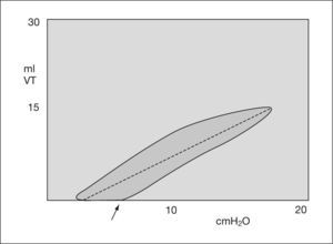 Gráfico de volumen-flujo. Distensibilidad baja. VT: volumen tidal.