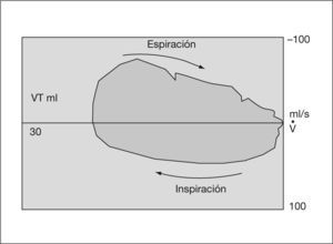 Gráfico de volumen-flujo. VT: volumen tidal.