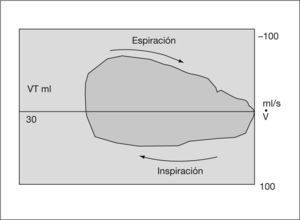 Gráfico de volumen-flujo. Resistencias elevadas. VT: volumen tidal.