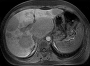 Resonancia magnética abdominal con múltiples nódulos hepáticos, algunos de ellos de gran tamaño.