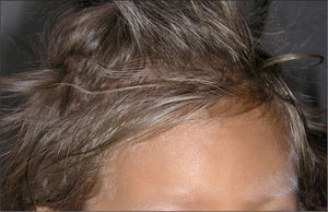 Piel bronceada, pelos y cejas plateadas encontradas en la paciente, características del síndrome de pelos plateados.