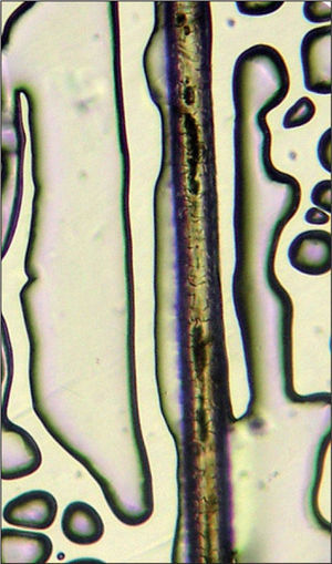 Microscopía de luz óptica, mostrando cúmulos de pigmento largos, irregularmente distribuidos en el pelo de la paciente.
