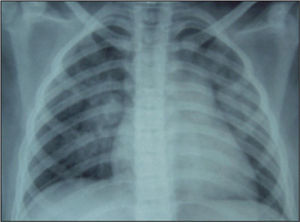 Radiografía de tórax al ingresar. Patrón alveolar parahiliar bilateral.